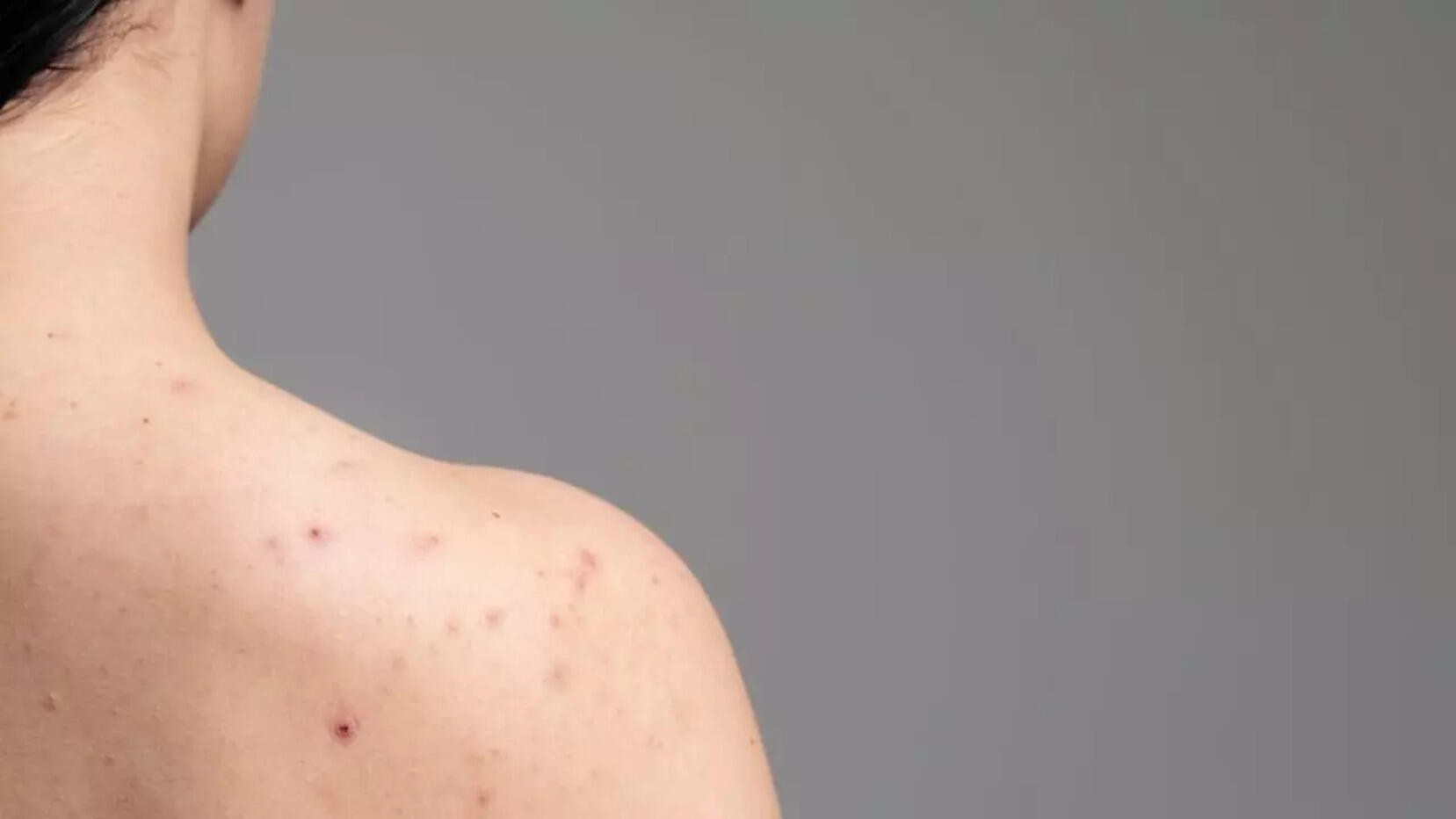 5 Best Body Wash To Treat Back Acne  Scars