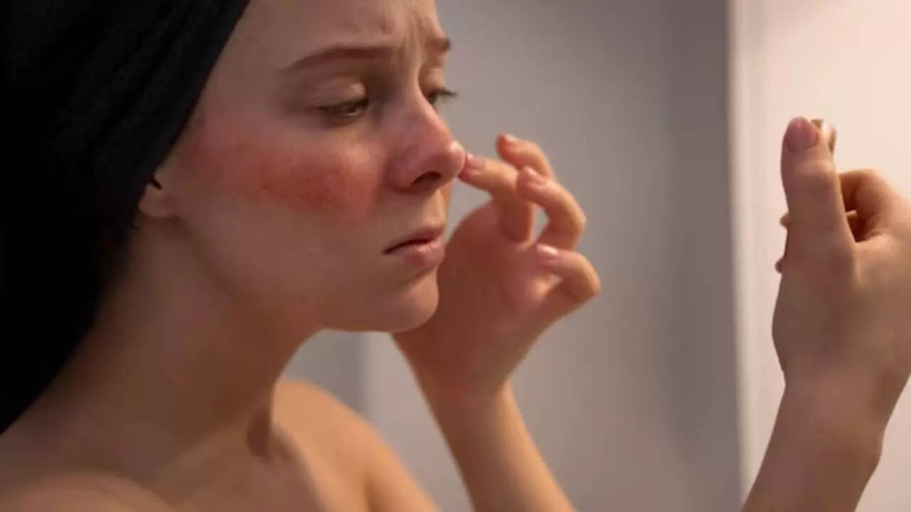 9 Best Sunscreens for Acne Prone Skin to Beat The Heat  