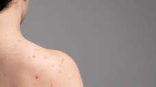 5 Best Body Wash To Treat Back Acne  Scars