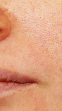 Effective Ways to Treat and Prevent Pigmentation Around the Mouth